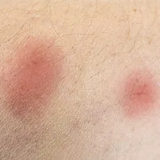 Bedbug Bites vs. Flea Bites image