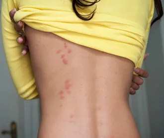 visible bedbug bites on the back of a woman standing in a room