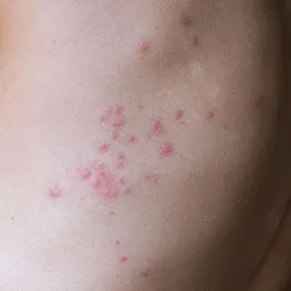 bedbug bites on woman's back