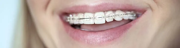 ceramic braces