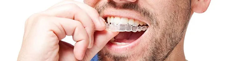 clear aligner