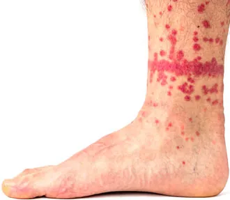 extreme case of flea bites on human ankle