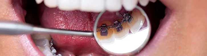 lingual braces