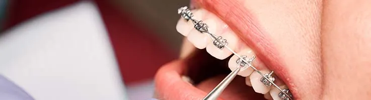 metal braces