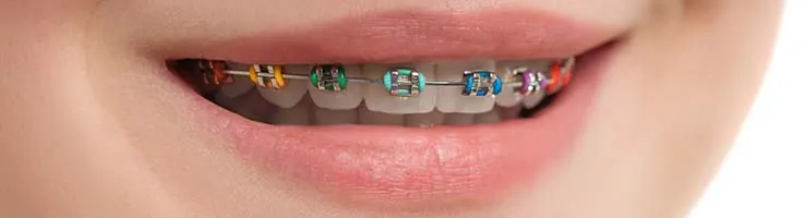 self ligating braces